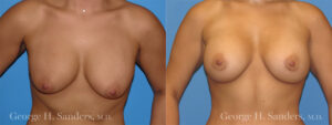Patient 1a Breast Capsules Before and After
