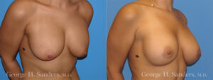 Patient 1b Breast Capsules Before and After