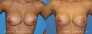 Patient 2a Breast Capsules Before and After