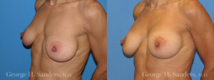 Patient 3c Breast Capsules Before and After