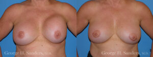 Patient 4a Breast Capsules Before and After