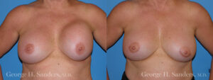 Patient 4a Breast Capsules Before and After
