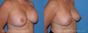 Patient 4b Breast Capsules Before and After