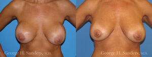 Patient 7a Breast Capsules Before and After