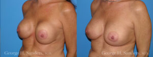 Patient 9c Breast Capsules Before and After