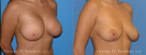 Patient 1c Implant Removal Before and After