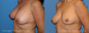 Patient 2b Implant Removal Before and After