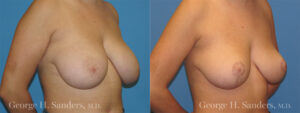Patient 1c Breast Reduction Before and After