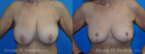 Patient 10a Breast Reduction Before and After