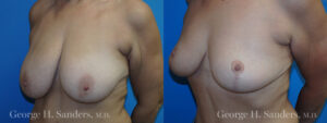 Patient 10b Breast Reduction Before and After