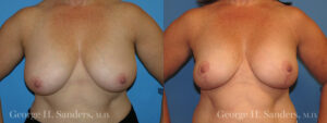 Patient 11a Breast Reduction Before and After