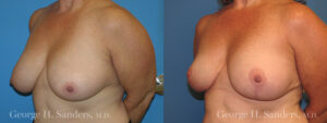 Patient 11b Breast Reduction Before and After