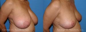 Patient 12b Breast Reduction Before and After
