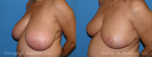 Patient 12c Breast Reduction Before and After