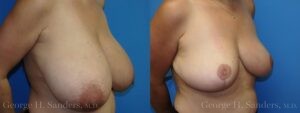 Patient 13b Breast Reduction Before and After