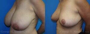 Patient 13c Breast Reduction Before and After