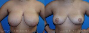 Patient 14a Breast Reduction Before and After