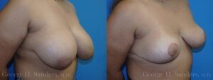 Patient 14b Breast Reduction Before and After