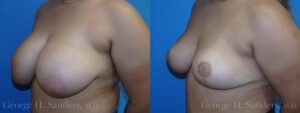 Patient 14c Breast Reduction Before and After