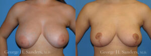 Patient 2a Breast Reduction Before and After