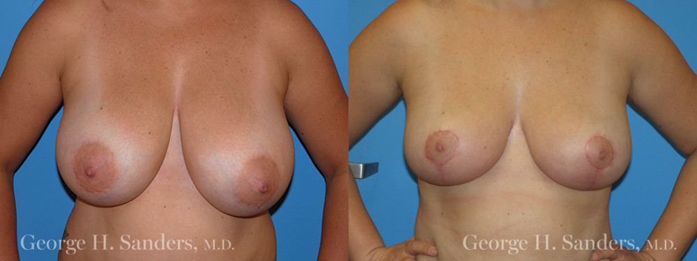 Patient 3a Breast Reduction Before and After