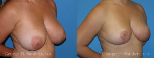 Patient 3b Breast Reduction Before and After