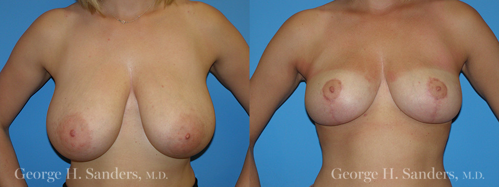 Patient 4a Breast Reduction Before and After