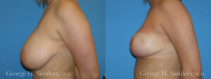 Patient 4b Breast Reduction Before and After