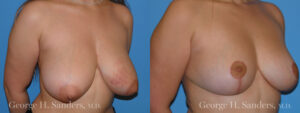 Patient 5b Breast Reduction Before and After