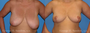 Patient 7a Breast Reduction Before and After