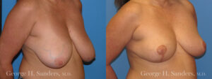 Patient 7b Breast Reduction Before and After