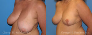 Patient 7c Breast Reduction Before and After