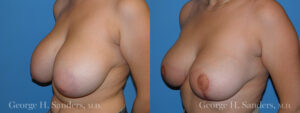 Patient 8b Breast Reduction Before and After