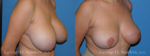 Patient 8c Breast Reduction Before and After
