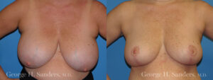 Patient 9a Breast Reduction Before and After