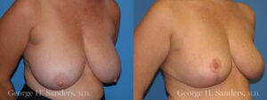 Patient 9b Breast Reduction Before and After