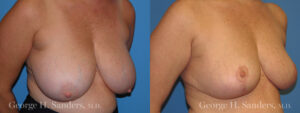 Patient 9b Breast Reduction Before and After
