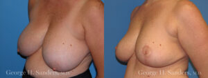 Patient 9c Breast Reduction Before and After