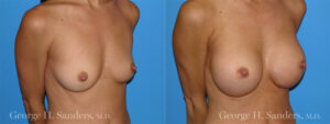 Patient 1c Breast Augmentation Before and After