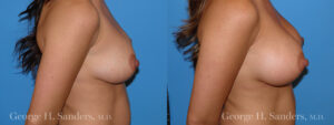 Patient 11b Breast Augmentation Before and After