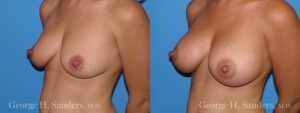 Patient 11c Breast Augmentation Before and After