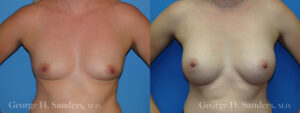Patient 12a Breast Augmentation Before and After