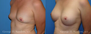 Patient 12b Breast Augmentation Before and After