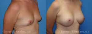 Patient 12c Breast Augmentation Before and After
