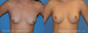 Patient 13a Breast Augmentation Before and After