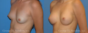 Patient 13b Breast Augmentation Before and After