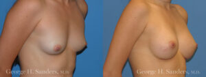Patient 13c Breast Augmentation Before and After