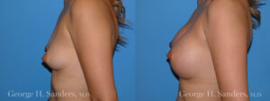 Patient 14c Breast Augmentation Before and After