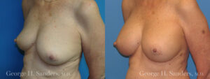 Patient 15b Breast Augmentation Before and After