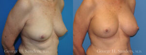Patient 15c Breast Augmentation Before and After